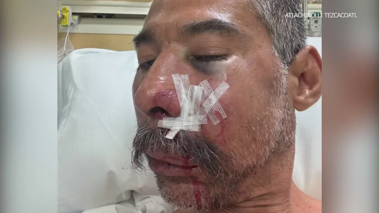 LAPD Accused of Breaking Man’s Jaw With Foam Round, Lawsuit Alleges