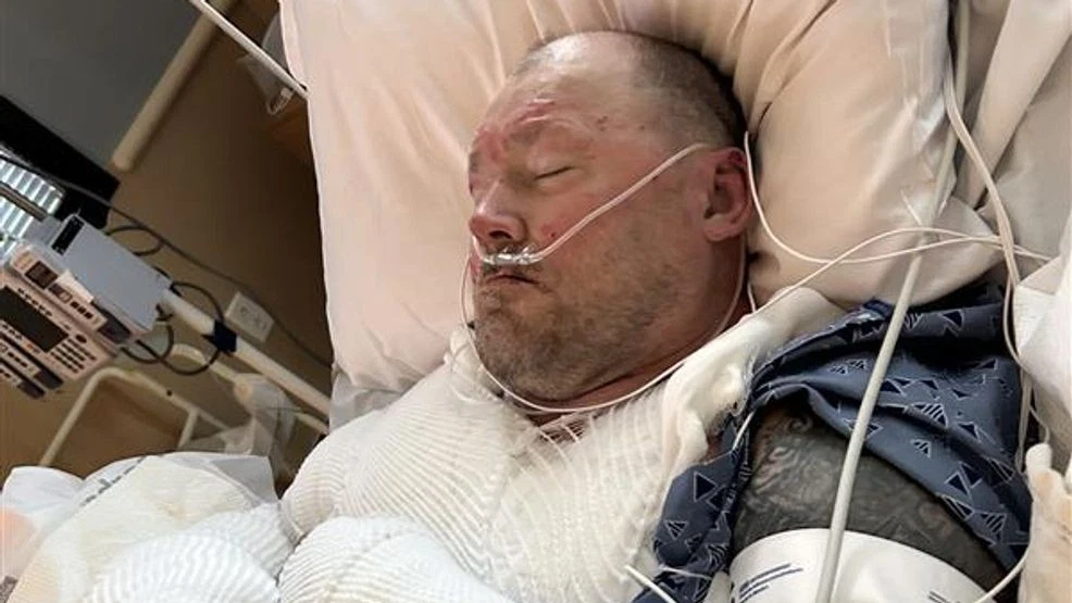 Taft Man Faces Long Recovery After Allegedly Being Set on Fire