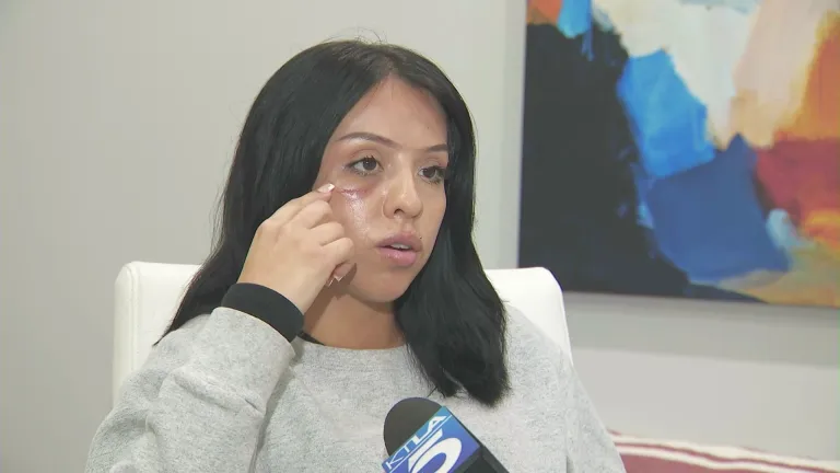 Protester shot in face with less-lethal round plans excessive force lawsuit against LAPD